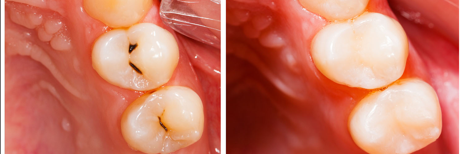 The image displays a close-up view of a human mouth with teeth showing signs of decay, specifically cavities, and the presence of a dental implant on one side.